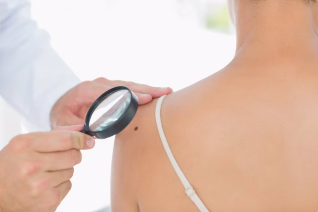 La inteligencia artificial se adelanta al cáncer de piel: predice el melanoma con años de anticipación